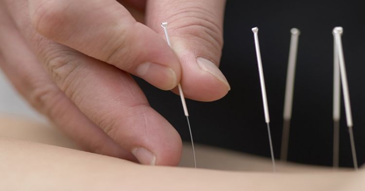 एक्यूपंक्चर का अर्थ, परिभाषा एवं कार्यप्रणाली - Meaning, Definition And Methodology Of Acupuncture