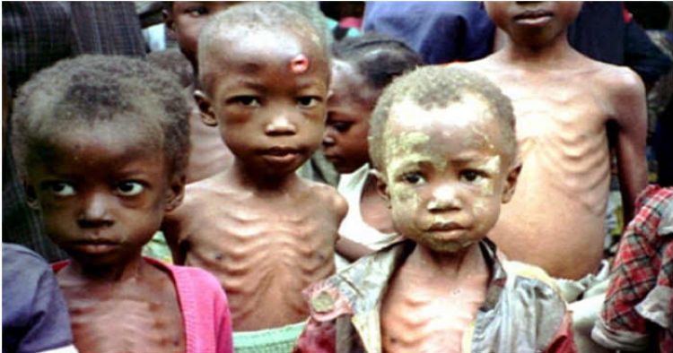 कुपोषण (Malnutrition) क्या होता है - कुपोषण के कारण,लक्षण और उपाए