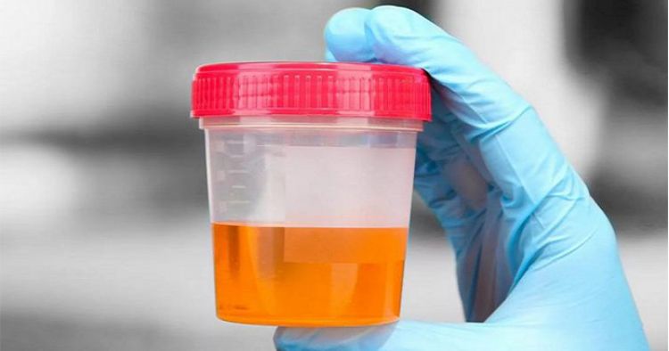 यूरिन (Urine Test) टेस्ट क्या है - यूरिन टेस्ट की नॉर्मल वैल्यूज, कब करना चाहिए, प्रक्रिया और घरेलू उपाए